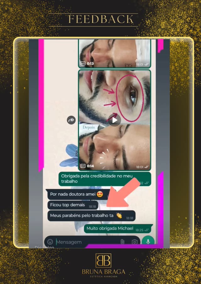 Depoimento de Michael sobre o resultado do procedimento na região dos olhos